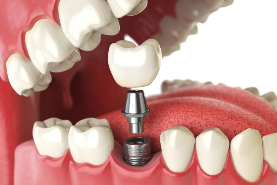 What are dental implants